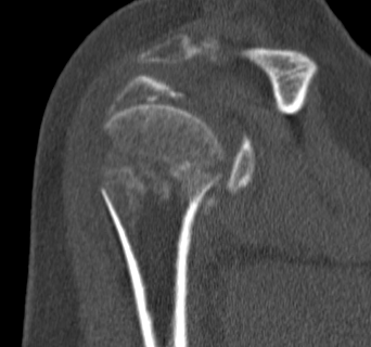 Surgical Neck of Humerus CT 4 Part Sagittal